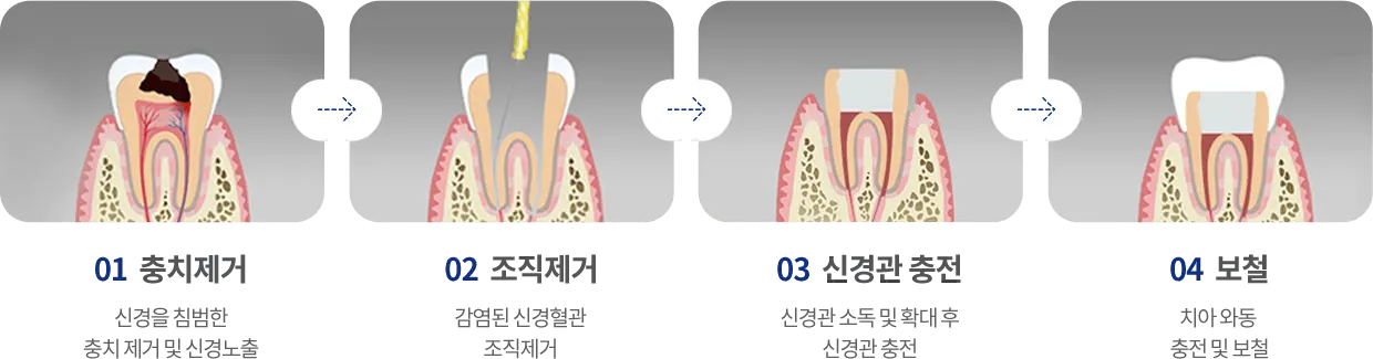 신경치료 과정