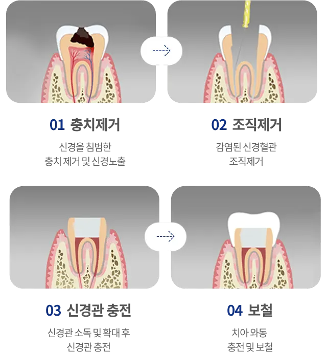 신경치료 과정