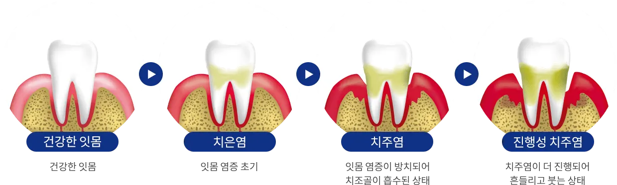 치주질환 진행 단계
