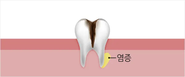 04. 이 뿌리까지 썩은</br>상태 [치수괴사]